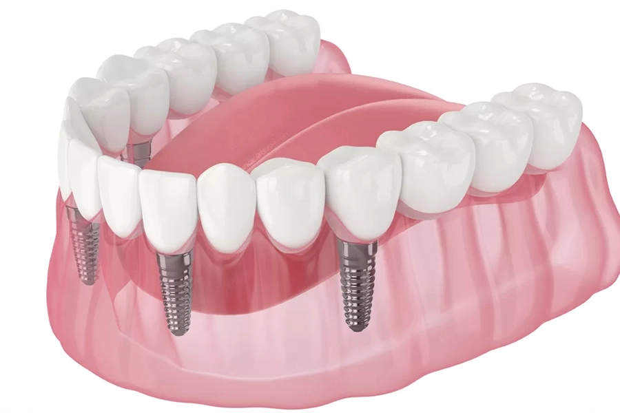 All-on-4 dental implants full arch restoration before and after at Sundent Dental Clinic Antalya