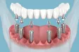 All on 6 Implants