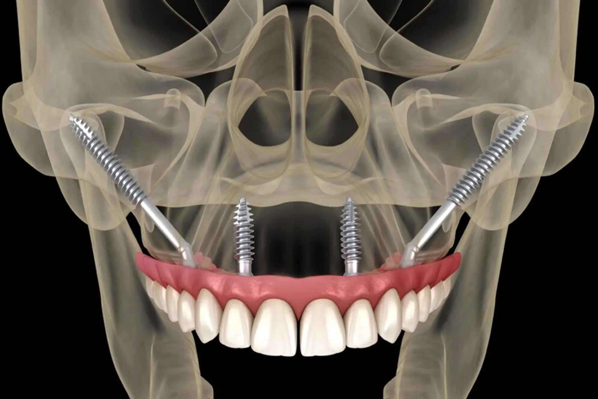 Zygomatic Dental Implants